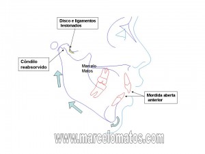 mordida aberta como conseqüência de alterações da ATM