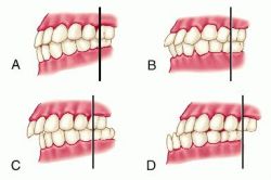 Classificação de Angle:  	 (A), Oclusão Normal; (B), má oclusão Classe I; (C), má oclusão Classe II; (D), má oclusão Classe III. Observe a posição da cúspide mesial dos molares superiores em relação ao molar inferior em cada tipo de oclusão