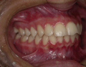 Oclusão dentária: Qual a relação com disfunção da ATM?
