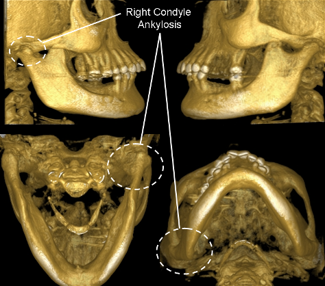 Cirurgia de ATM e Tratamentos Alternativos