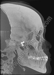 Imagem de hemiface esquerda mostrando a placa metálica 