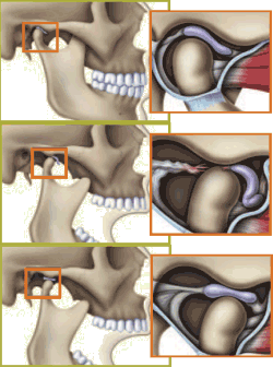 ATM Rio - Um dos sintomas da DTM são os estalos na mandíbula. Se a sua mandíbula  estala frequentemente, fica presa, trava ou até sai do lugar marque a sua  consulta pois