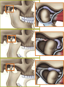 Articulação estalando é sempre sintoma de DTM (Disfunção  Temporomandibular)?