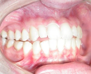 Mordida aberta decorrente de processo degenerativo da ATM, com encurtamento do ramo mandibular e protusão da língua