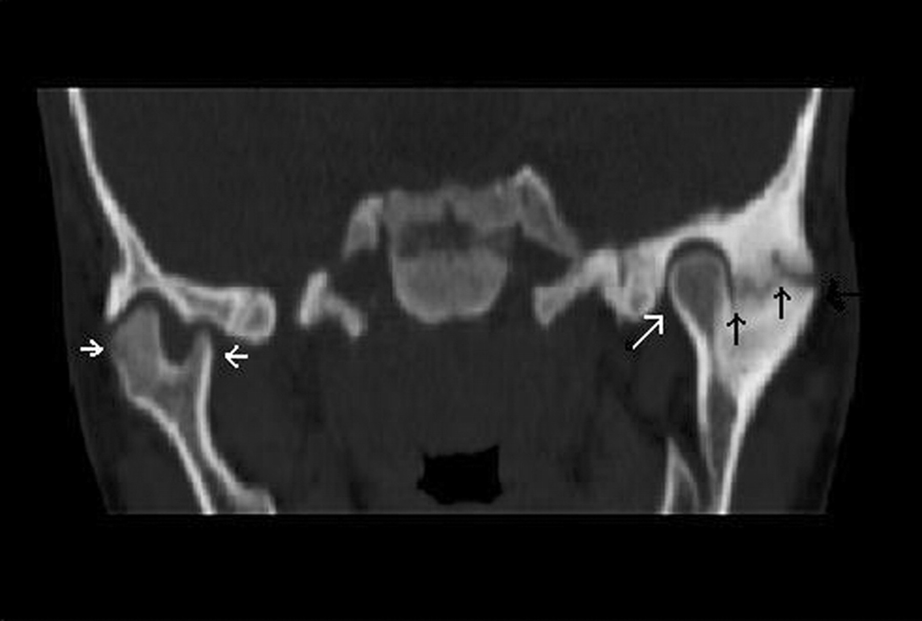 Cirurgia de ATM e Tratamentos Alternativos