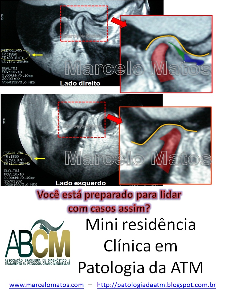 Mini residência em disfunção da ATM