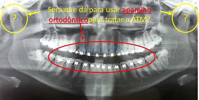 Tratamento ortodôndico e disfunção da ATM - Portal Patologia da ATM