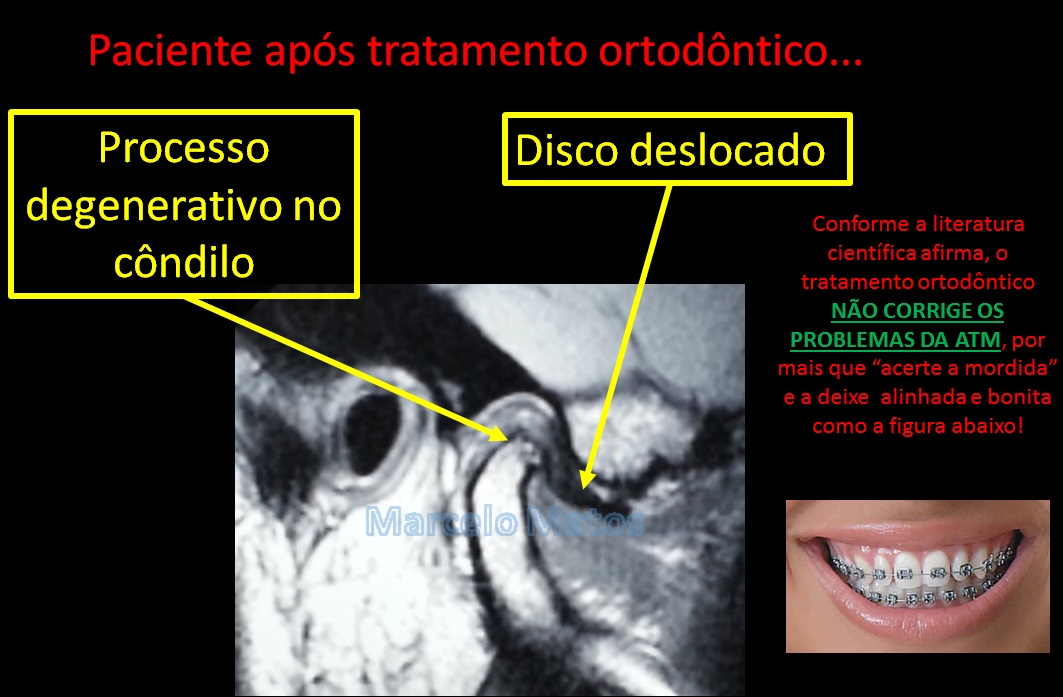Tratamento ortodôndico e disfunção da ATM - Portal Patologia da ATM