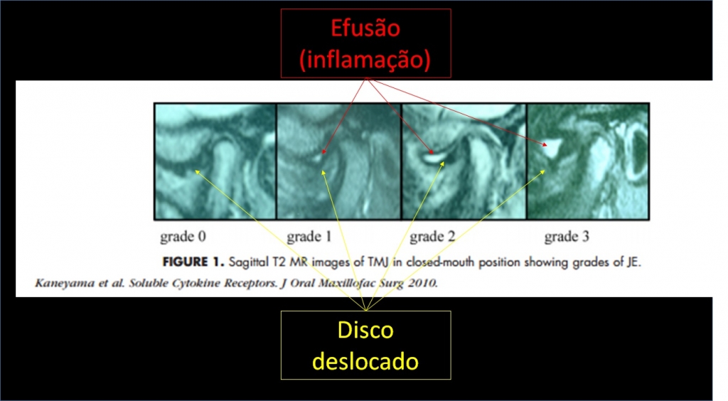 inflamação atm 2