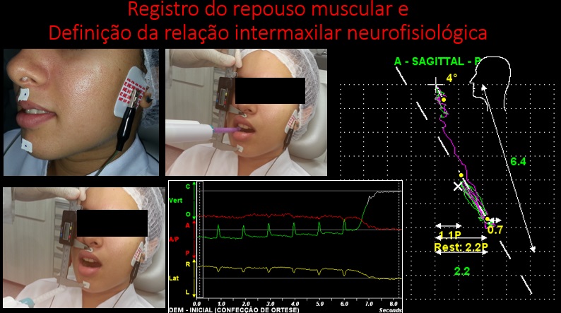 Tensão na face e o diagnostico de DTM muscular - Portal Patologia