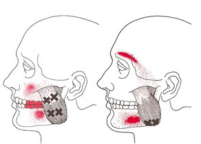 Tensão na face e o diagnostico de DTM muscular - Portal Patologia