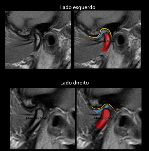 Tensão na face e o diagnostico de DTM muscular - Portal Patologia