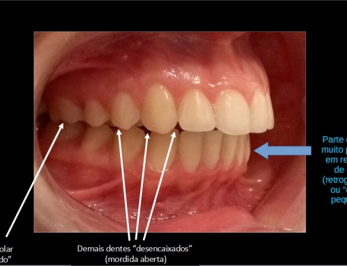 Tratamento de degeneração da ATM sem cirurgia? / Treatment of TMJ degeneration without surgery?