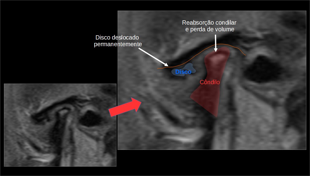 Quando a cirurgia da ATM falha - Portal Patologia da ATM