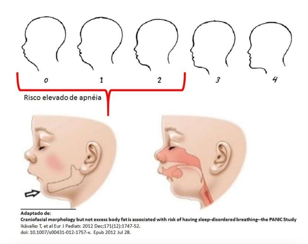 A mandíbula travada está relacionada com problemas na articulação  temporomandibular, conhecida como ATM. O disco articular dessa área pode  entrar em descompasso e se deslocar, o que resulta no incômodo e travamento