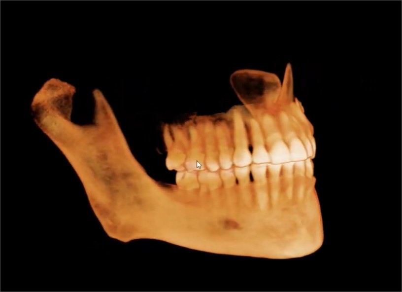 Barulhos no ouvido? Pode ser a Articulação temporomandibular – Dr