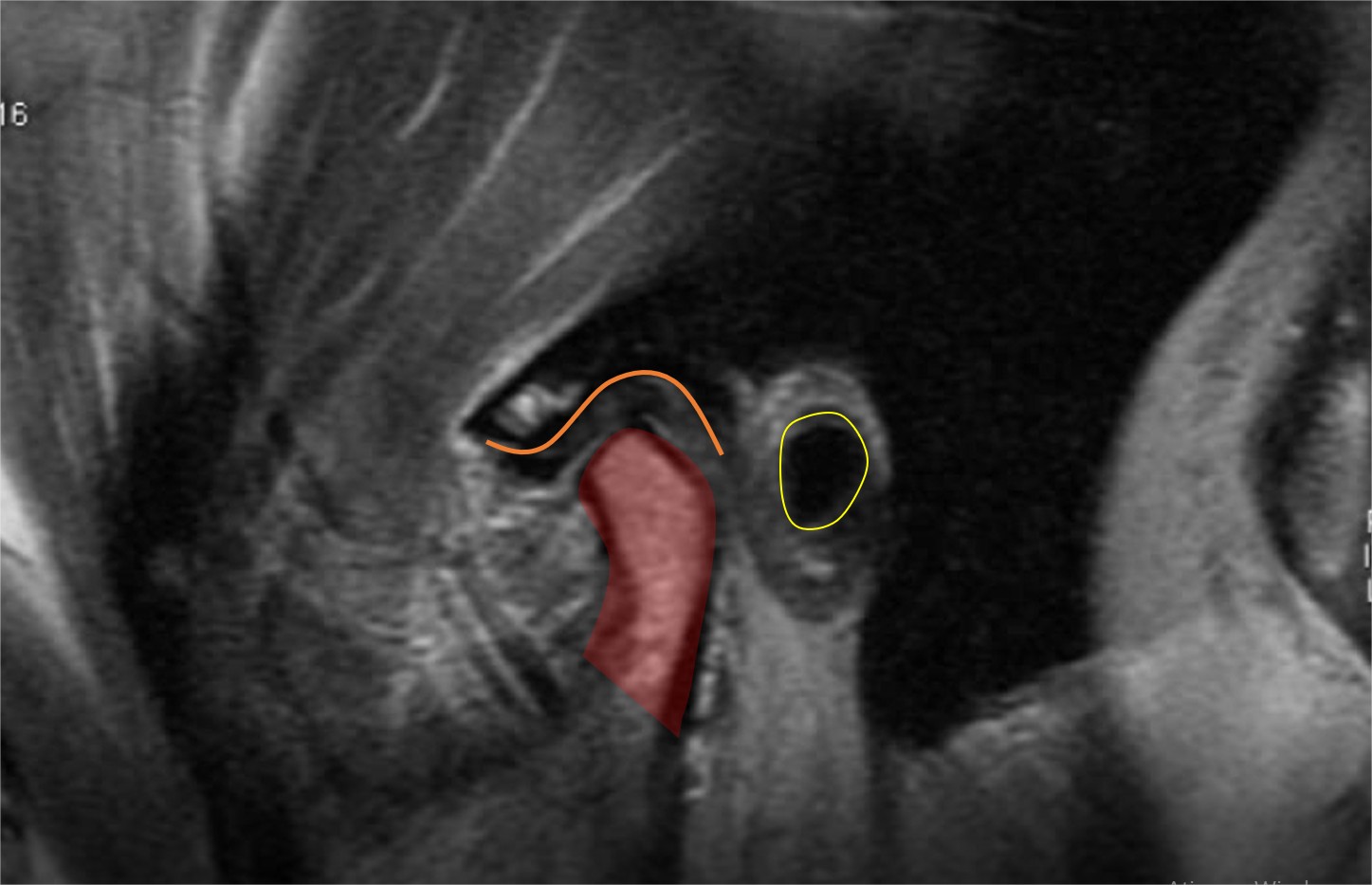 A mandíbula travada está relacionada com problemas na articulação  temporomandibular, conhecida como ATM. O disco articular dessa área pode  entrar em descompasso e se deslocar, o que resulta no incômodo e travamento