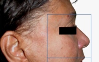 Harmonização facial por recuperação da proporção áurea