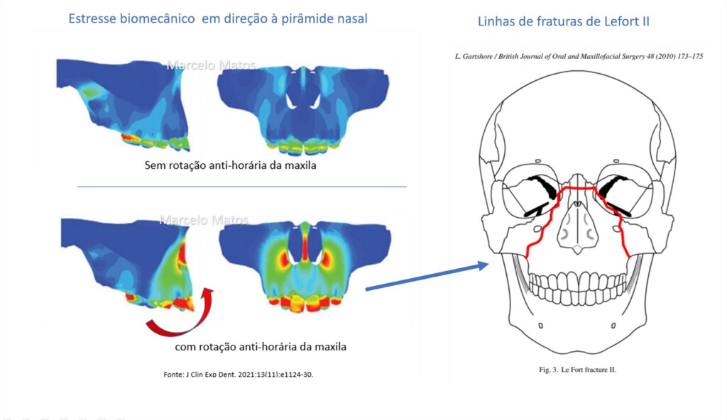 Dor em pirâmide nasal