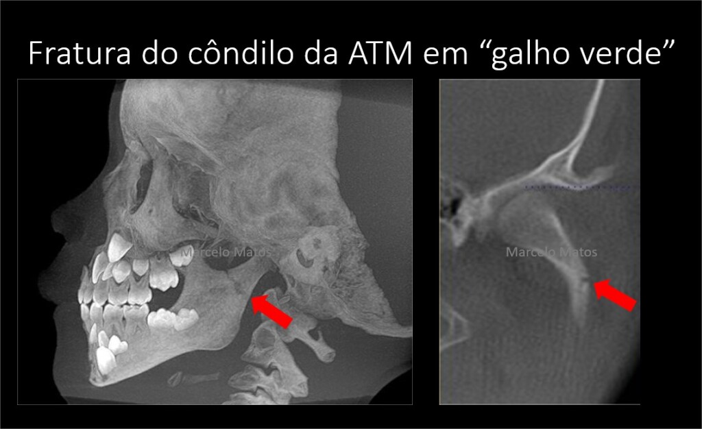 Fratura em galho verde da ATM