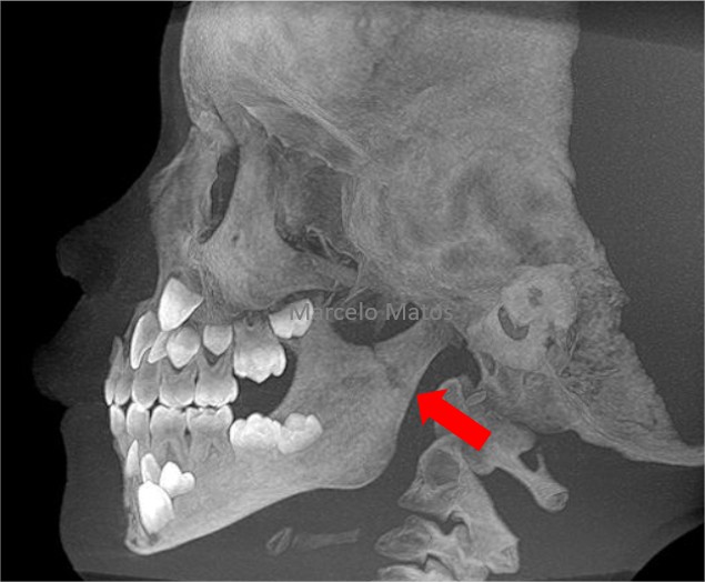 Por que alongar a mandíbula? Porque quase todos nós já cerrou os dentes